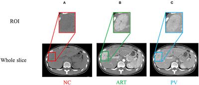 Phase Attention Model for Prediction of Early Recurrence of Hepatocellular Carcinoma With Multi-Phase CT Images and Clinical Data